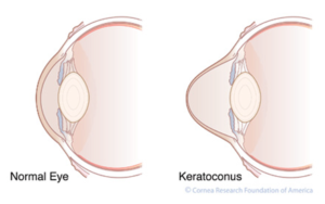 Keratoconus | Lang Family Eye Care | New Berlin, WI Eye Doctor