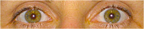 Lazy Eye Amblyopia How it Looks| New Berlin, WI Eye Doctor | Lang Family Eye Care